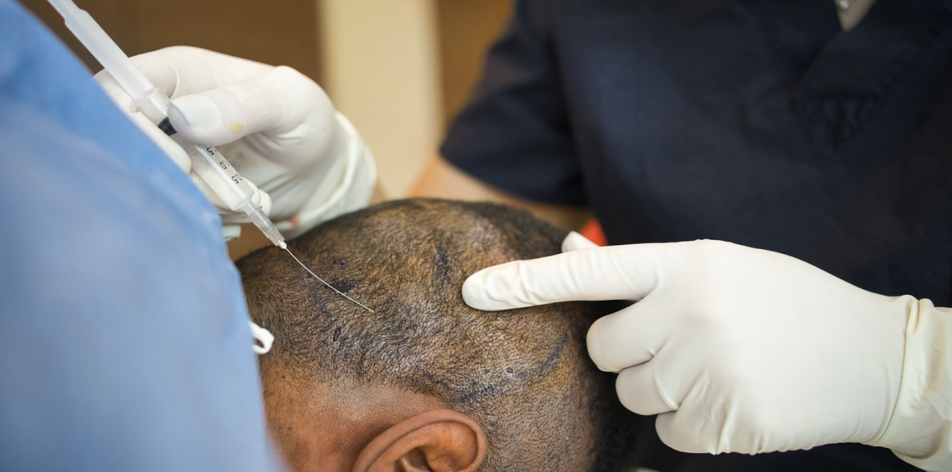 How To Choose A Hair Transplant Surgeon In Timonium Trusted Dermatologist