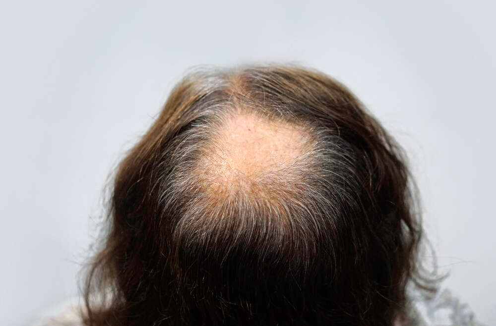 Can Lasers Help Grow Hair Back?