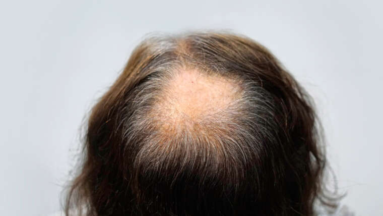 Can Lasers Help Grow Hair Back?