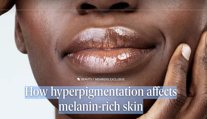 How Hyperpigmentation Affects Melanin Rich Skin