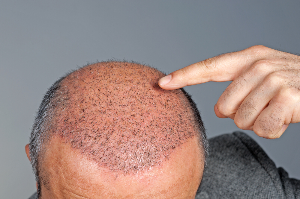 Hair transplants with NeoGraft
