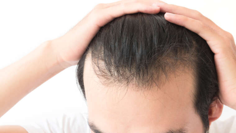 How Long Does a Hair Transplant Last in Columbia, Maryland?