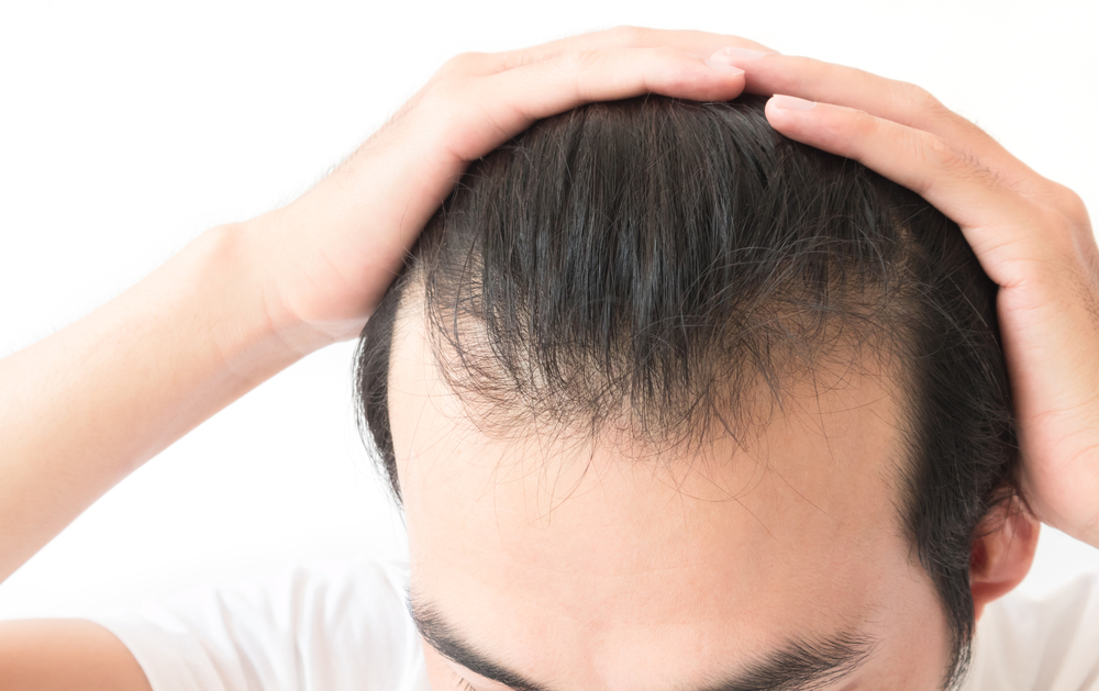 How Long Does a Hair Transplant Last in Columbia, Maryland?