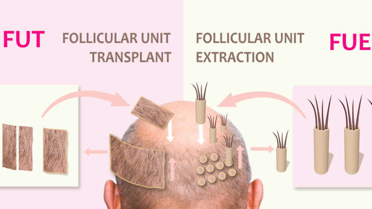 FUE or FUT: What Are the Best Hair Transplants?