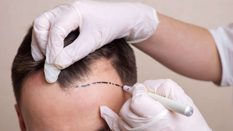 Permanent Hair Transplant Doctor in Columbia, Maryland