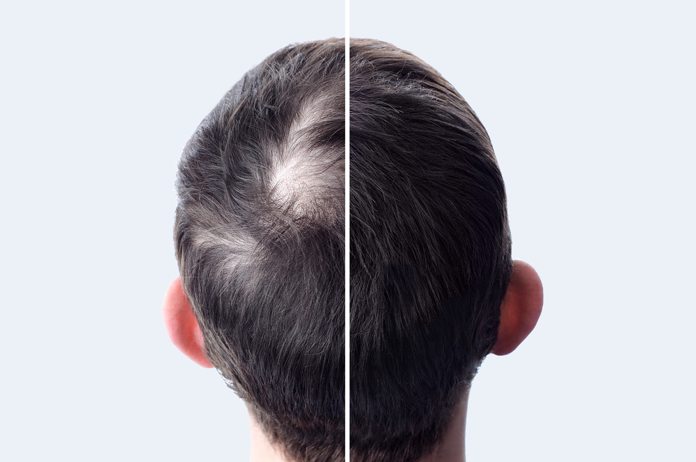 Hair Transplant Pricing Near Baltimore, Maryland - Trusted Dermatologist