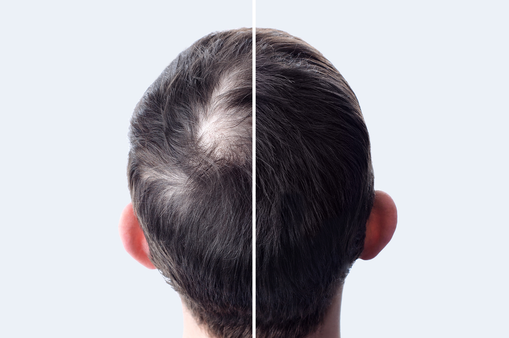 Hair Transplant Pricing Near Baltimore, Maryland