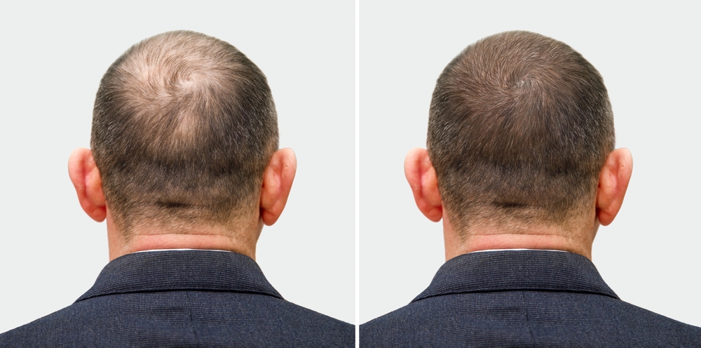 Natural Looking Hair Transplants in Ellicott City, Maryland