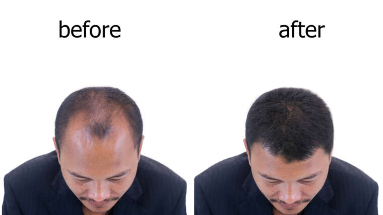 Hair Transplant Costs in Baltimore, Maryland: What to Expect