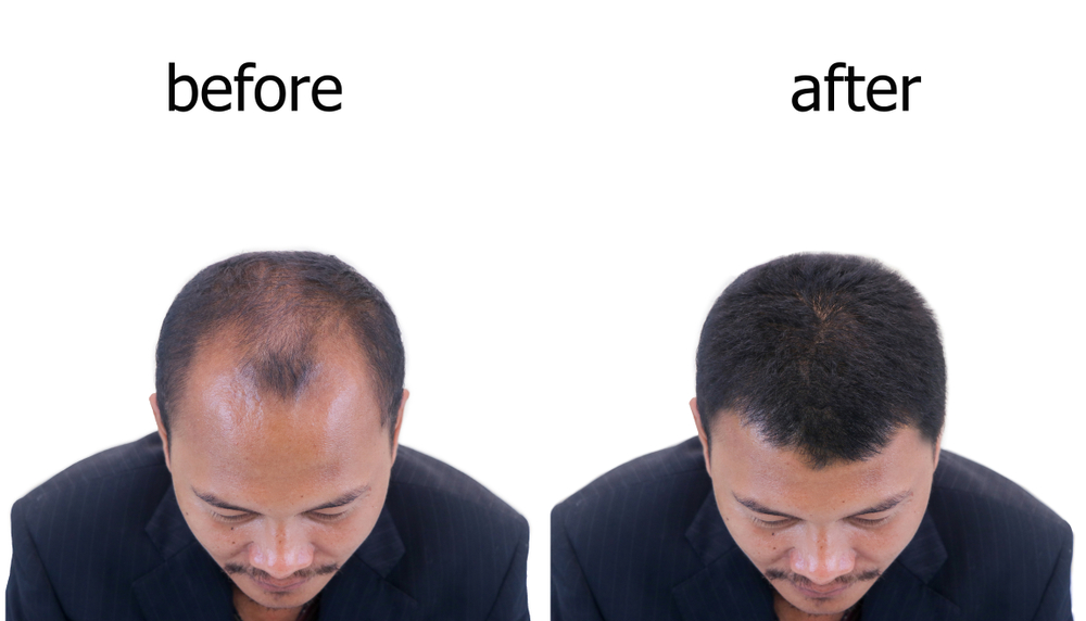 Hair Transplant Costs in Baltimore, Maryland: What to Expect