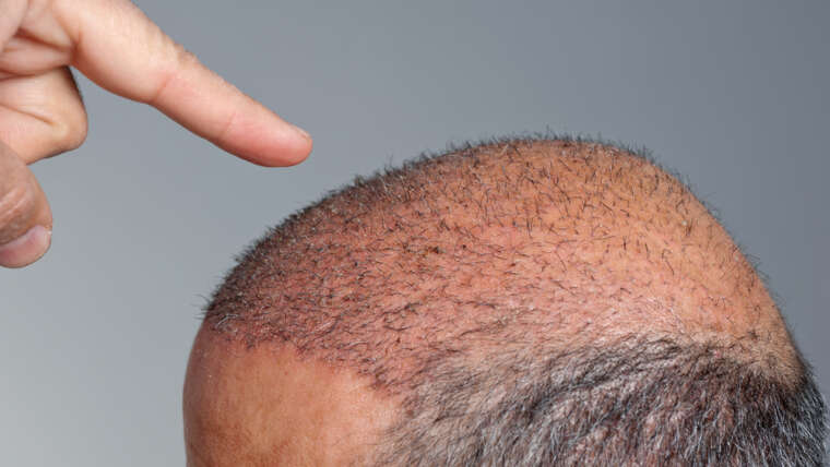 Best Hair Transplant Cost in Jessup, Maryland