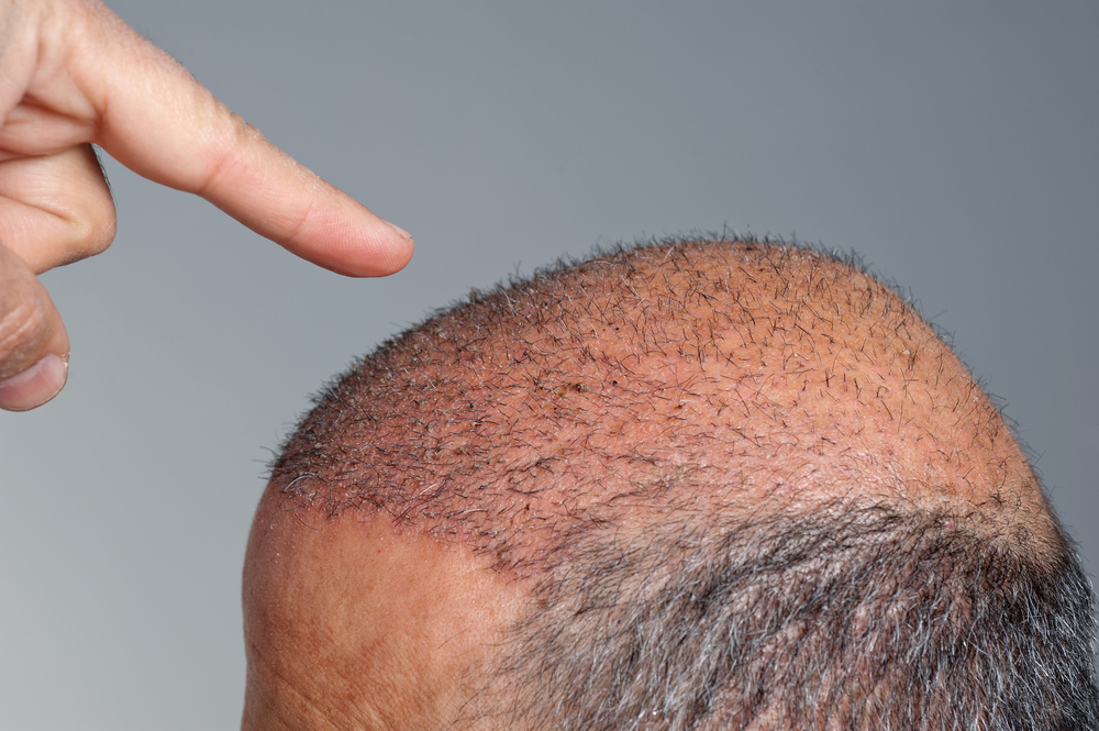 Best Hair Transplant Cost in Jessup Maryland