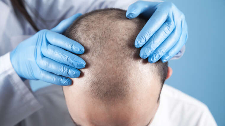 Free Hair Transplant Consultationation in Baltimore, Maryland: What to Expect