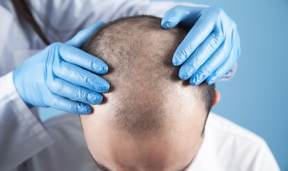 Free Hair Transplant Consultationation in Baltimore