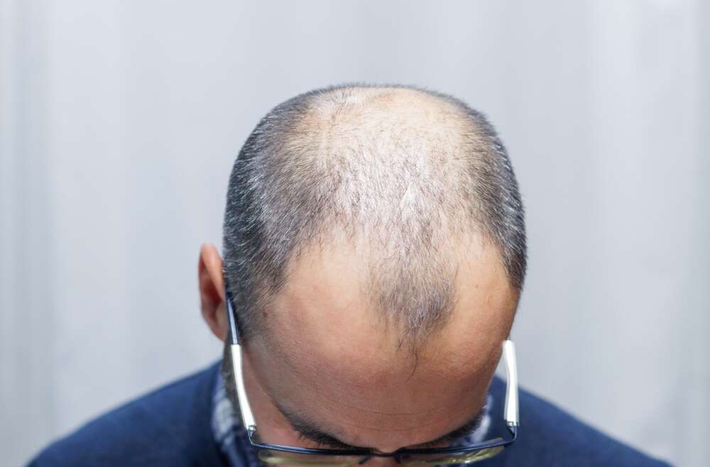 What Age Is Best for a Hair Transplant?