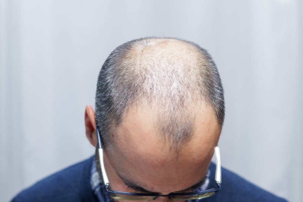 What Age Is Best for a Hair Transplant?