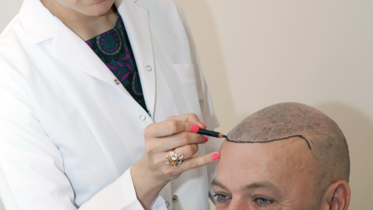 Get the Best Hair Transplant, FUE vs. FUT in Maryland