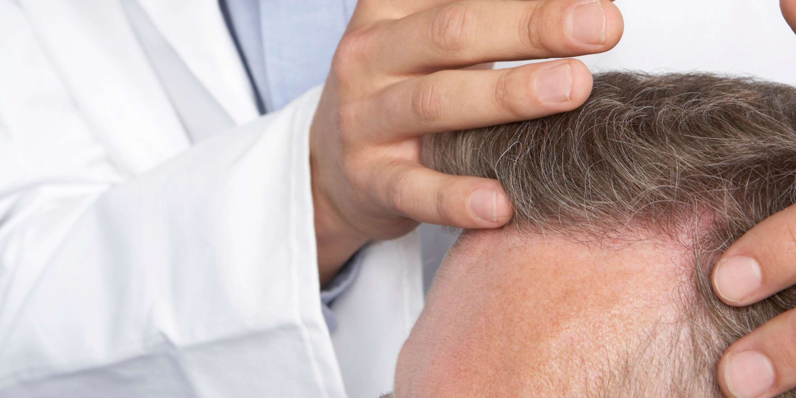 How Much Does a 2,000 Hair Graft Cost? Trusted Dermatologist