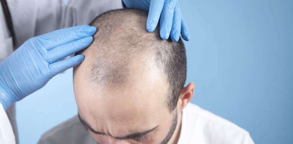 hair grafts cost