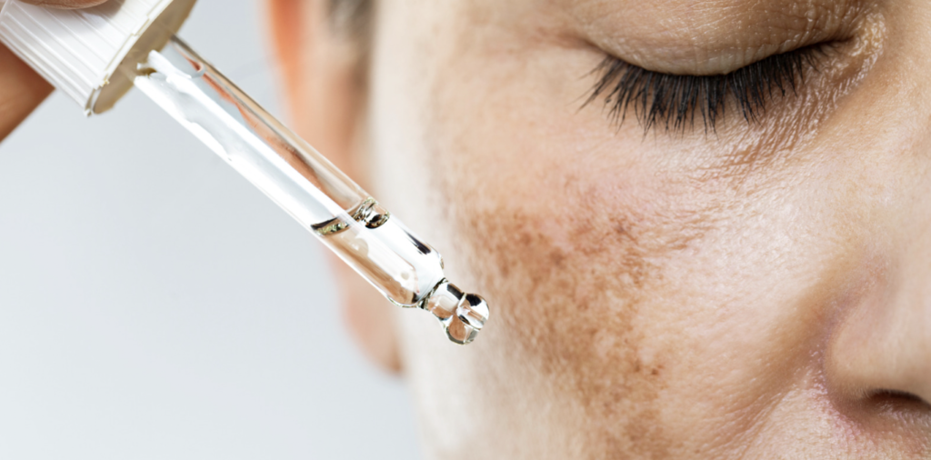 Best Melasma Treatment