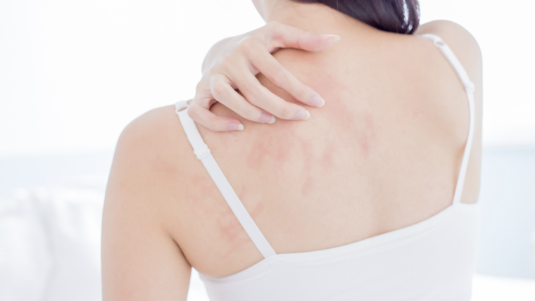Atopic Dermatitis Research Trial in Maryland