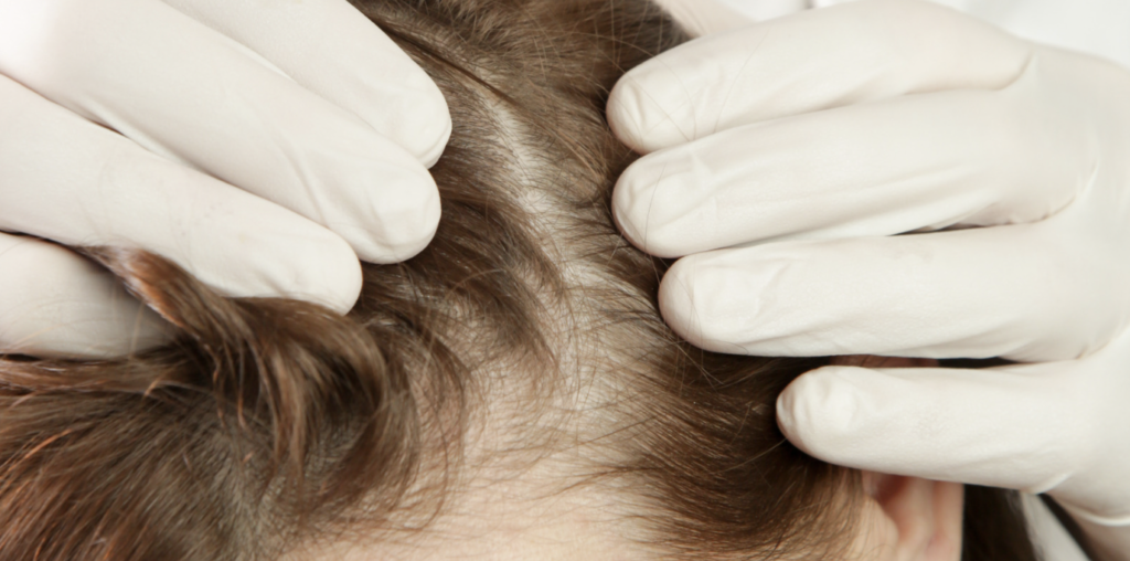 top Hair Loss Doctor in Maryland