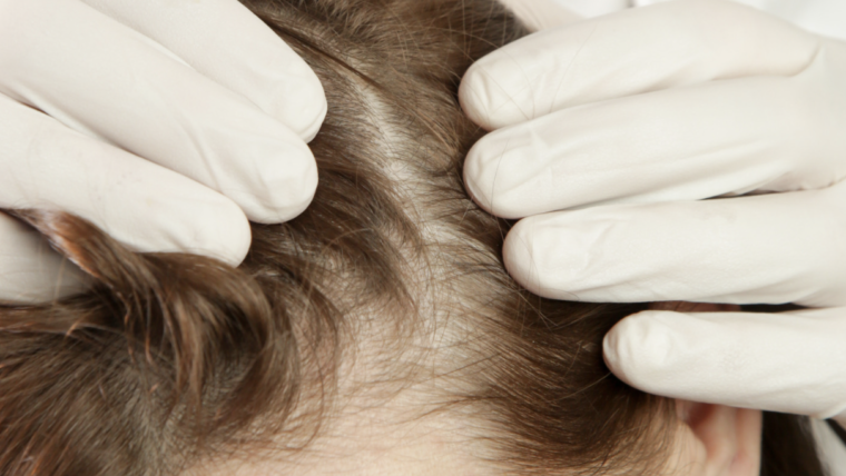 Top Hair Loss Doctor in Maryland