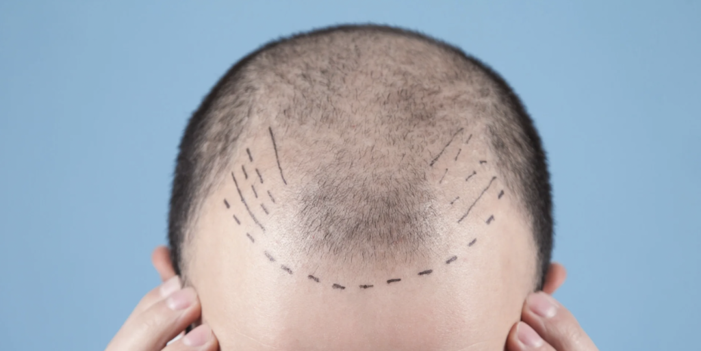 Hair Transplant Consultationation Near Columbia