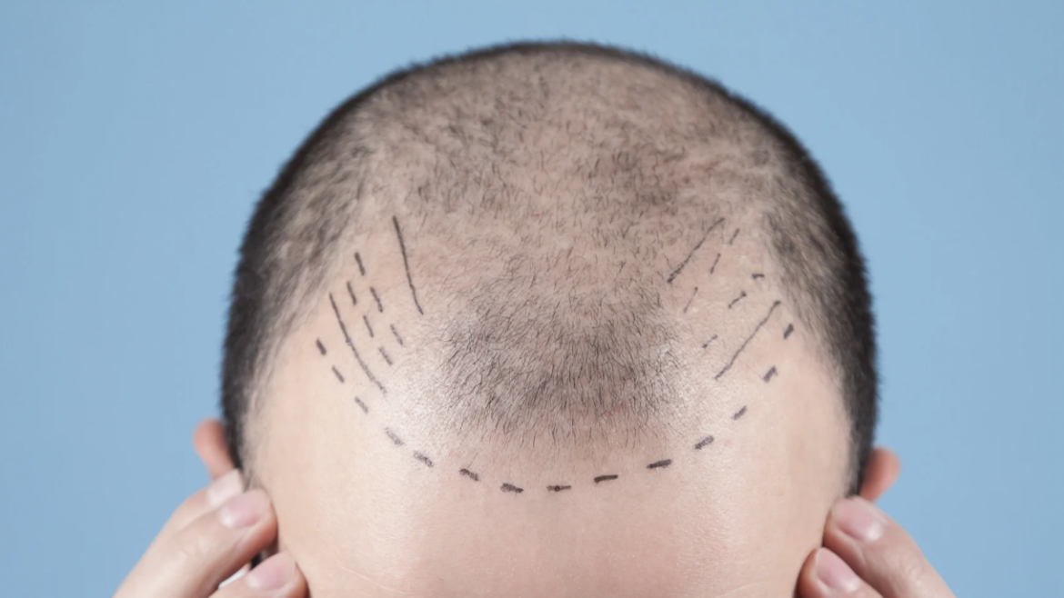 Hair Transplant Consultationation Near Columbia, MD