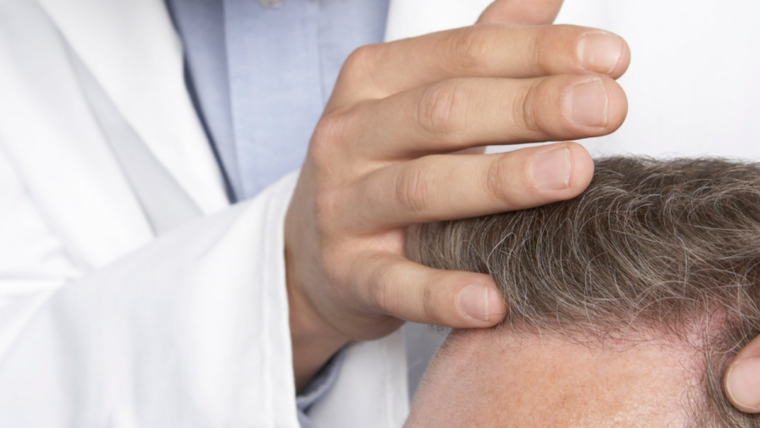 How Maryland Residents Are Restoring Confidence with Hair Transplants