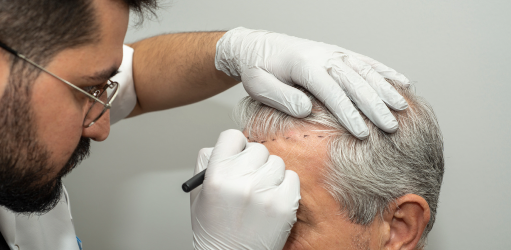 Hair Transplant Options in Maryland