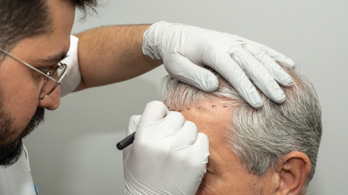 Hair Transplant Options in Maryland