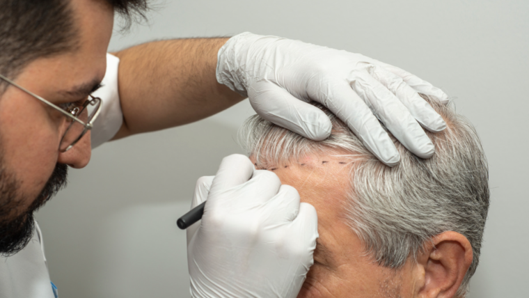 Hair Transplant Options in Maryland