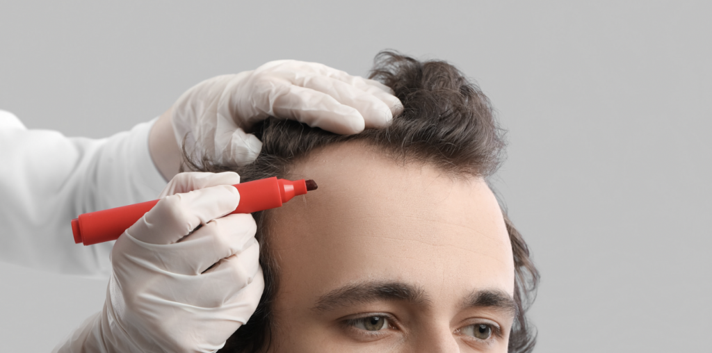 Hair Transplant Costs in Maryland