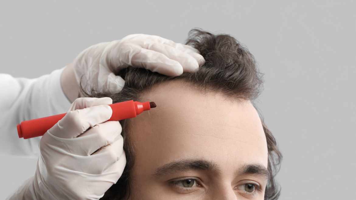 The Ultimate Guide to Understanding Hair Transplant Costs in Maryland