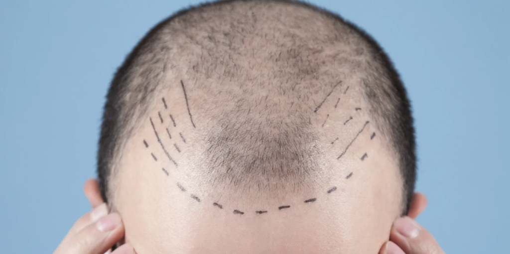 Hair Transplant Costs in Silver Spring Maryland