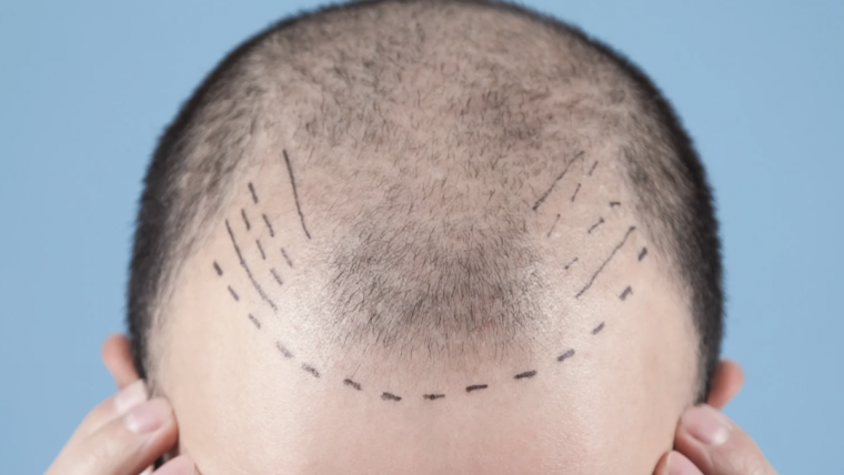 Understanding Hair Transplant Costs in Silver Spring, Maryland
