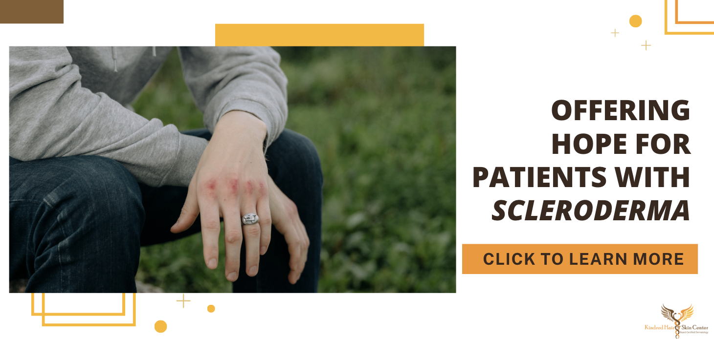 offering hope for patients with scleroderma