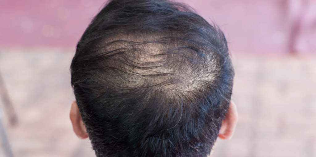 Find the Best Hair Loss Doctor in Maryland