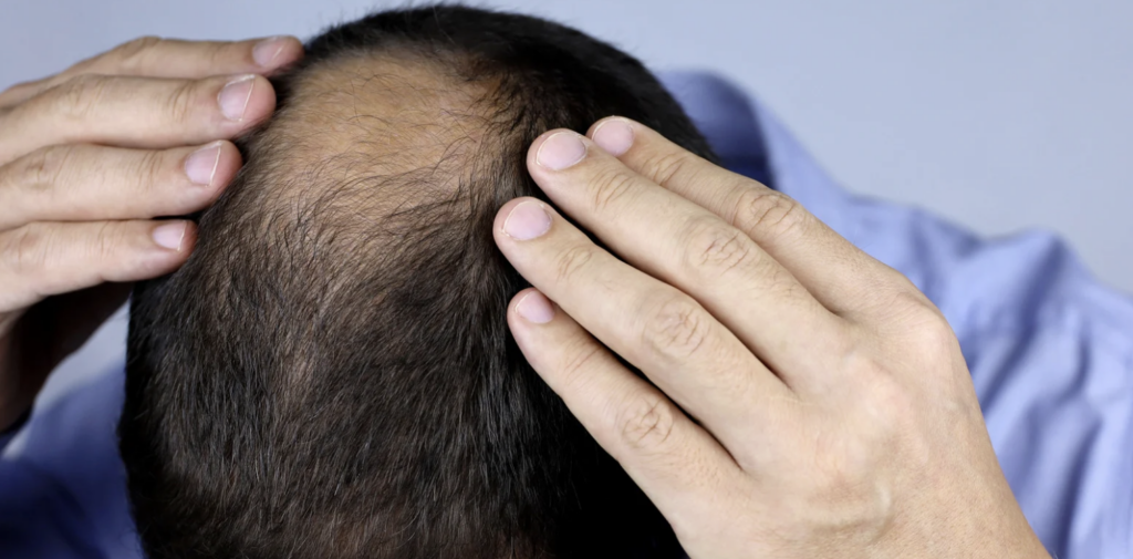 Hair Graft Transplant Appointment Near Bethesda MD