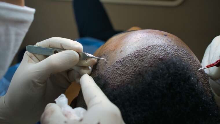 How to Achieve the Best Hair Transplant Results in 2025