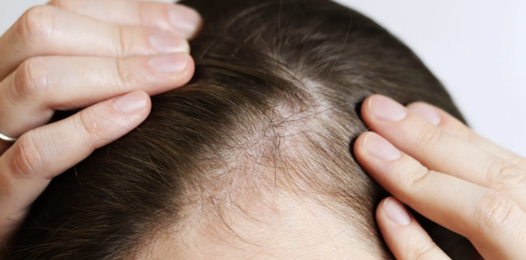 Female Hair Loss Specialist Near Glen Burnie Maryland