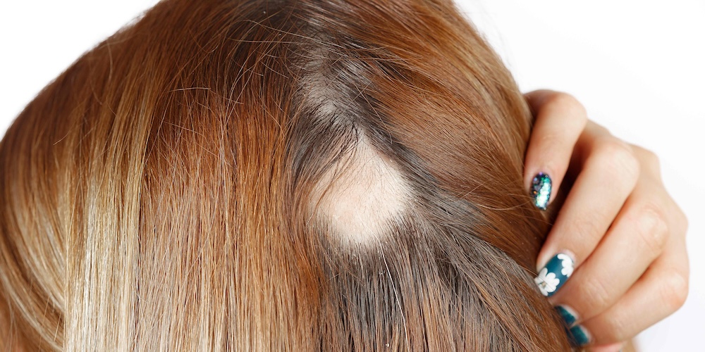 Black Dermatologists for Traction Alopecia Treatment Near Silver Spring, Maryland