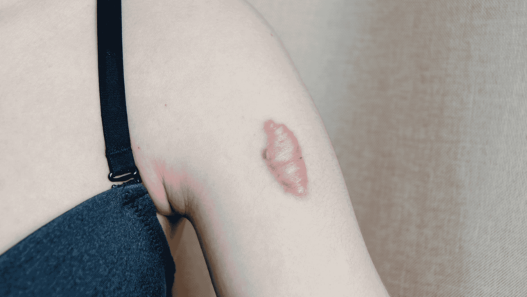 Highly Sought-After Black Dermatologist for Keloid Treatment in Bowie, MD